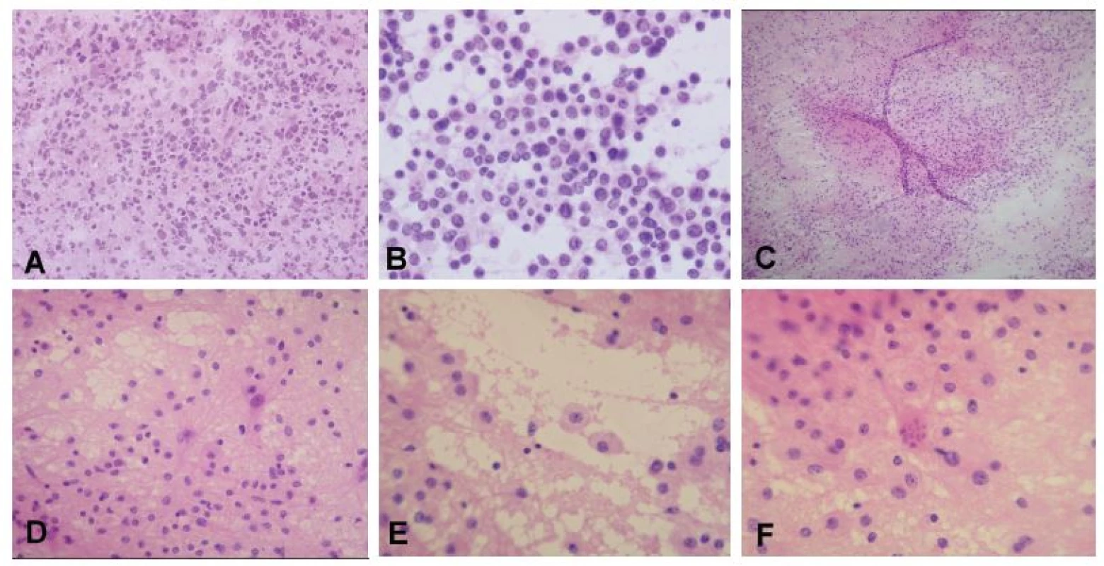 (A, B) Periventrikulárny tumor u 75-ročnej ženy. V zmrazenom reze jasná nádorová infiltrácia, typ nádoru však nemožno spoľahlivo stanoviť (A). V náterovej
cytológii bola zachytená diskohezívna lymfoidná populácia buniek, niektoré iba s nahými jadrami, iné s tenkým lemom cytoplazmy. Na pozadí početné
tzv. lymfoglandulárne telieska - fragmenty cytoplazmy po rozpade buniek. Jadrá majú vzhľad prevažne centrocytrov (B). Peroperačná diagnóza: high-grade
lymfóm. Definitívna diagnóza: difúzny veľkobunkový B-lymfóm (DLBCL). (C-F) Supratentoriálne ložisko u 21-ročnej ženy. Náter bol na prvý pohľad celulárny
a pôsobil „nádorovo“ (C). Pri bližšom pohľade ale bolo jasné, že sa jedná o heterogénnu populáciu buniek, ktorá je tvorená reaktívnymi astrocytmi s jemnými
pravidelnými dlhými výbežkami, malými lymfocytmi a makrofágmi s objemnou svetlou jemne granulárnou cytolplazmou (D, E). V ložiskách demyelinizácie (ale
aj iných procesoch s reaktívnou astrocytózou) sa často vyskytujú neobvyklé astrocyty s fragmentovaným jadrom – tzv. Creutzfeldtove bunky (F). Peroperačná
diagnóza: akútna zápalová demyelinizácia, jednoznačný nádor nie je prítomný. Definitívna diagnóza: ložisko aktívnej demyelinizácie sugestívne pre diagnózu
sclerosis multiplex.
