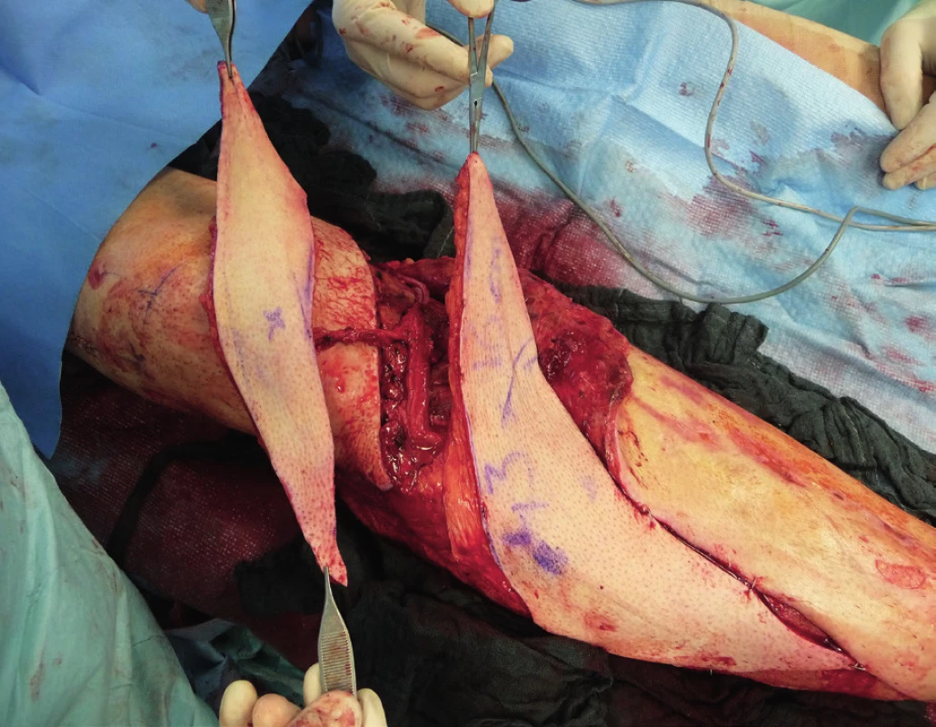 Because of the advantage of satisfactory soft tissue on
the thigh, the ALT flap was chosen. It was harvested as a twocomponent
flap consisting of muscle and skin parts (divided
into two parts). The size of ALT flap was 43 x 16 cm covering the
entire length of exposed tibia and tibia fixation plate