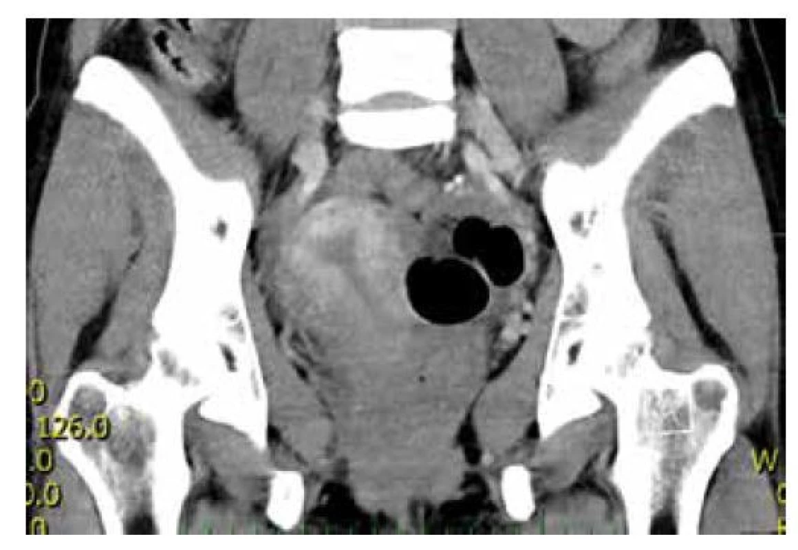 CT s dělohou deviovanou doprava a uskřinutým ileem<br>
Fig. 4: CT with the uterus deviated to the right and incarcerated
ileum