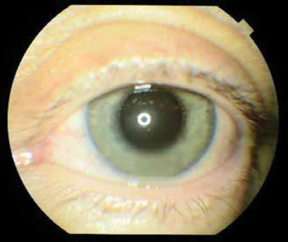 Left eye at 1st examination, hyperaemia of conjunctiva,
precipitates on cornea, Tyndall effect in anterior
chamber, hypopyon, hyperaemia of iris
