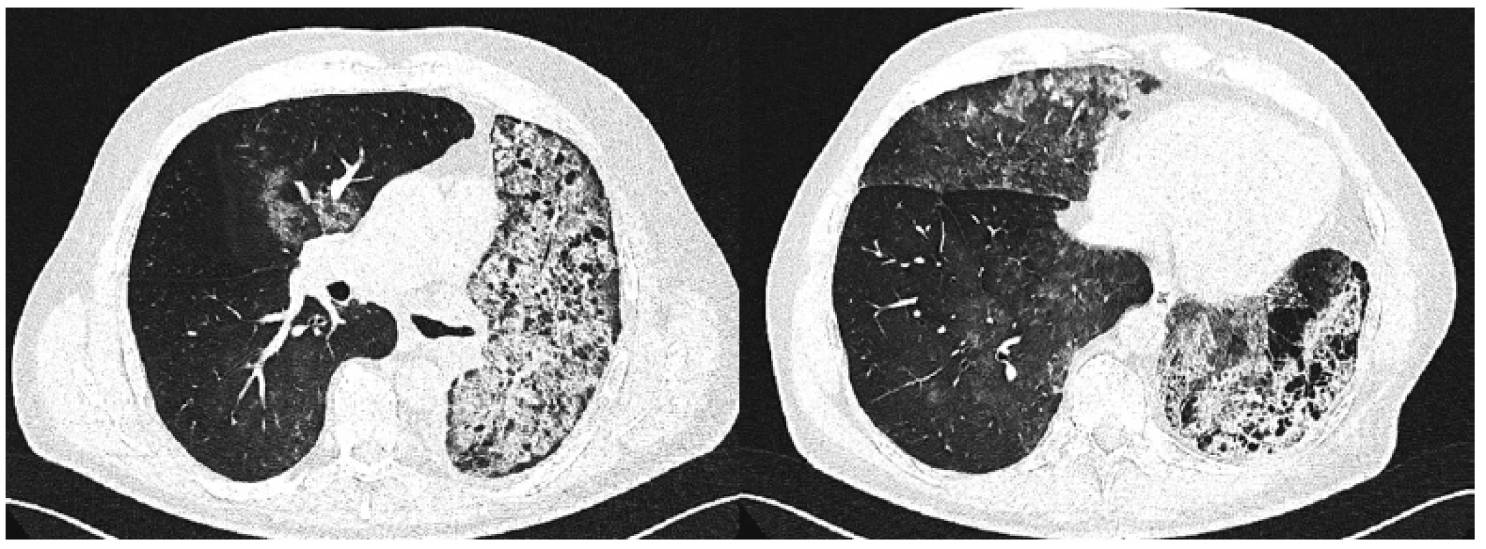 Počítačová tomografie s vysokou rozlišovací schopností u pacienta s hereditární plicní alveolární proteinózou