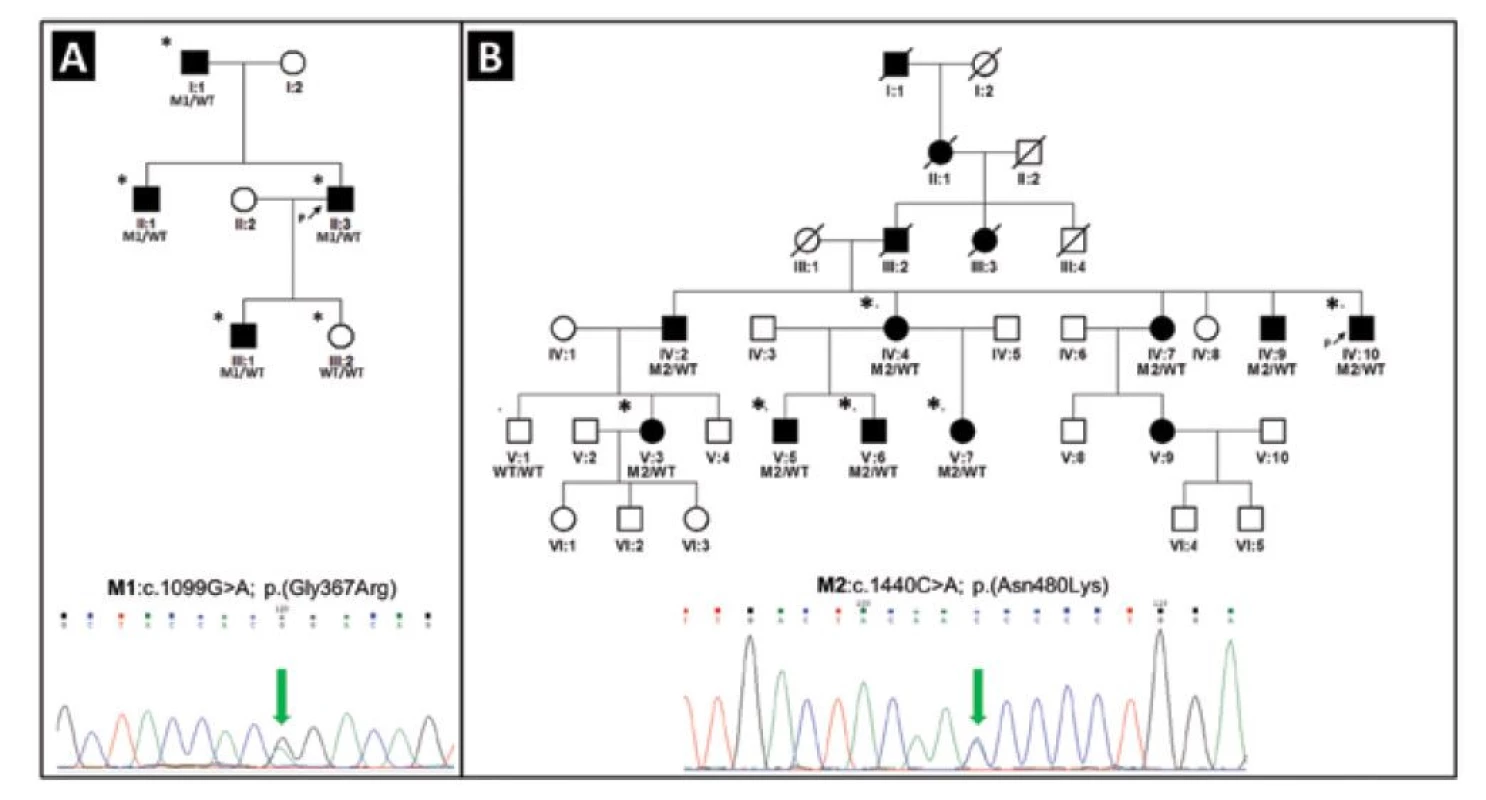 Rodokmeny dvou rodin s PGOÚ na podkladě patogenních variant v genu MYOC. Rodina č. 1 s mutací M1
c.1099G>A v heterozygotním stavu, která byla detekována u čtyř postižených jedinců (A). Rodina č. 2 s mutací M2
c.1440C>A v heterozygotním stavu, která byla prokázána u devíti postižených jedinců (B). Probandi jsou označeni černou
šipkou, jedinci klinicky vyšetřeni alespoň jedním z autorů hvězdičkou, černé kolečko označuje ženu s PGOÚ, černý
čtvereček muže s PGOÚ. Výsledky genetického testování genu MYOC jsou ukázány pouze u molekulárně geneticky
vyšetřených jedinců. Všichni prokázaní nositelé patogenních variant vykazovali známky PGOÚ (diagnóza PGOÚ u jedinců,
kteří nebyli vyšetřeni na našem pracovišti [tj. IV:2, IV:7, IV:9] byla stanovena na jiném pracovišti, což bylo ověřeno na
základě dostupných lékařských zpráv). WT označuje referenční sekvenci (anglicky „wild type“)