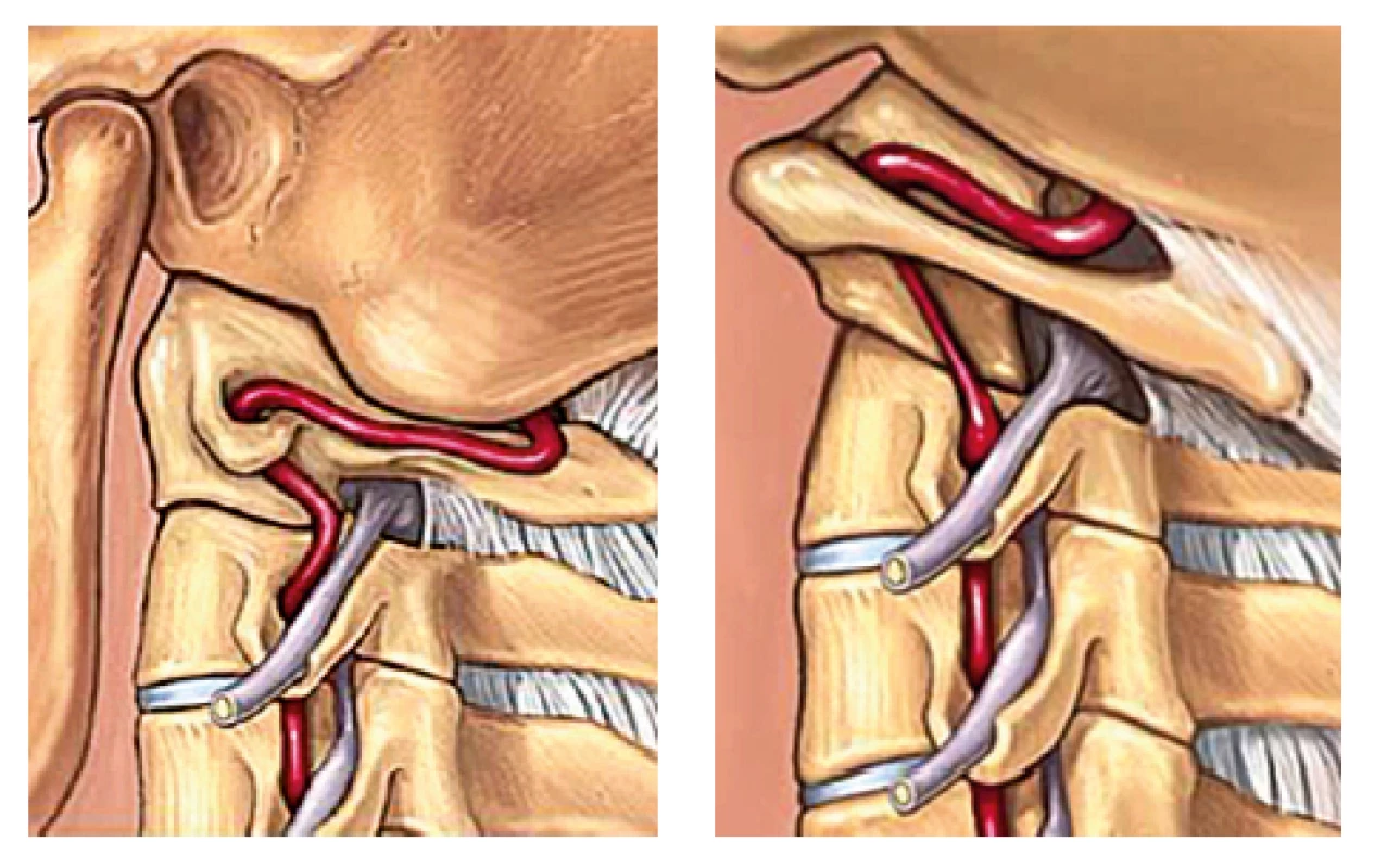Rotácia krku spôsobuje hlavne v oblasti okcipitálno–
atlanto–axiálneho spojenia natiahnutie a kolienkovité ohnutie
vertebrálnej artérie.