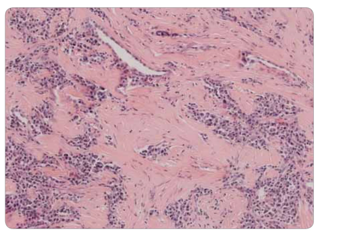 Histológia infl amatórneho myofi broblastického tumoru pľúc: subpleurálne solidizácia
a hyalinizácia, masívna prímes plazmocytov, farbenie hematoxylínom a eozínom,
zväčšenie 20×.