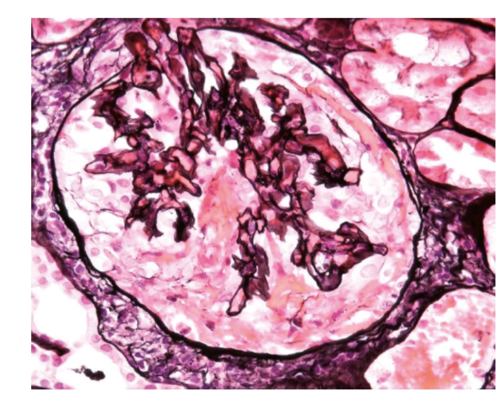 Biopsie ledviny, zachycený glomerulus je částečně
postižen sklerotizací, je vidět fibrózní srpek (1), není přítomný
polymorfonukleární infiltrát, který by znamenal aktivní postižení
