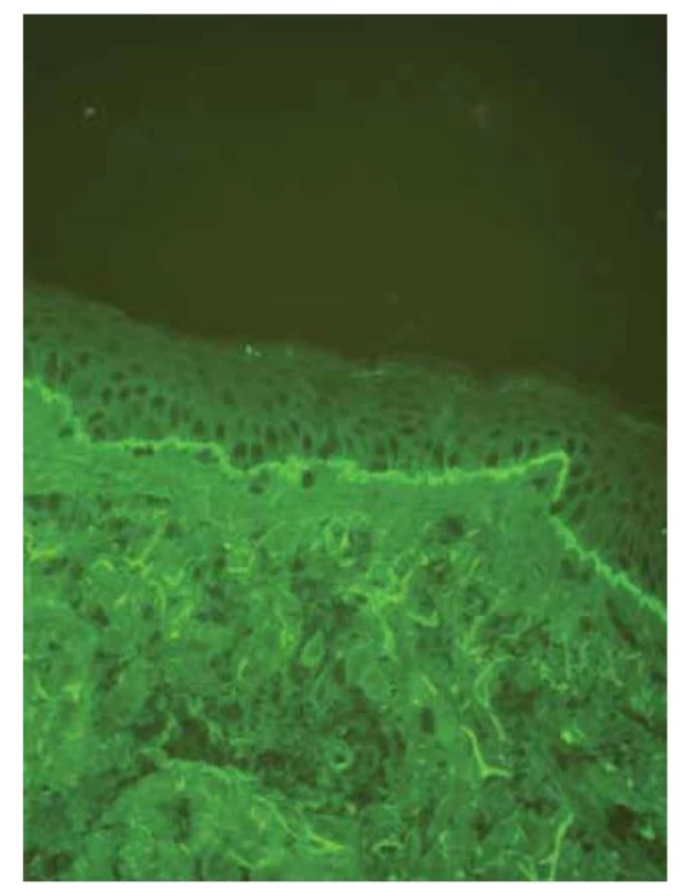 V přímé imunofluorescenci patrný lem tvořený C3
složkou komplementu pod epidermis s n-vroubkováním