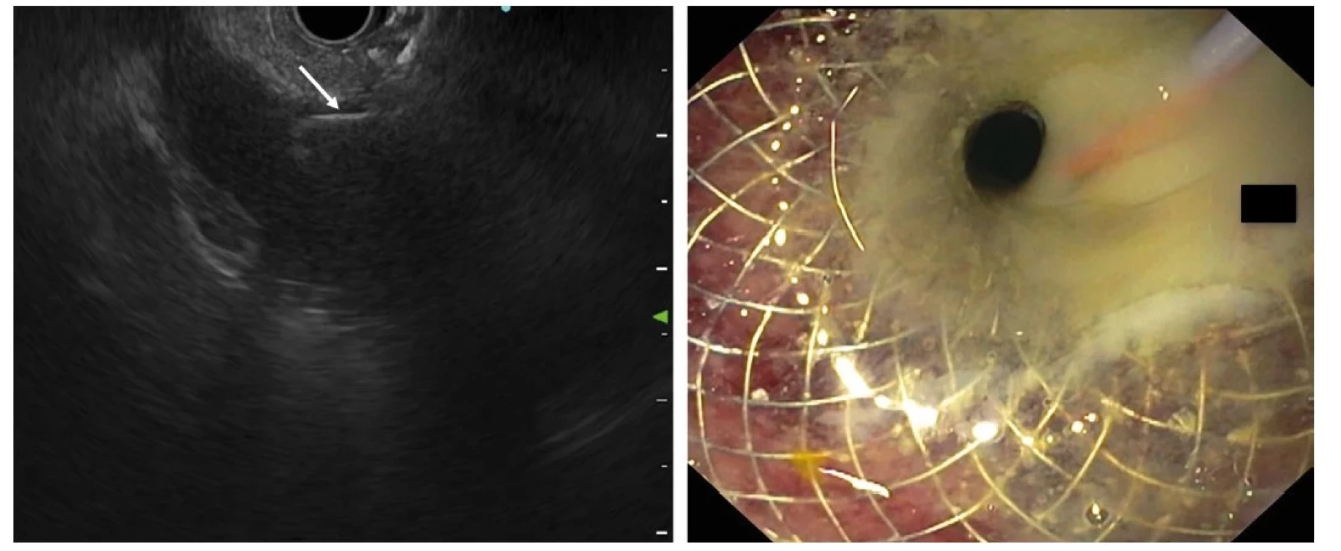 Endoskopická cholecystoduodenostomie – vlevo endosonografický obraz akutní kalkulózní cholecystitidy s pericholecystitidou a empyémem,
patrný transduodenálně zavedený lumen apoziční stent (část ve žlučníku označena bílou šipkou), vpravo je duodenální část stentu se zavedeným vodičem
a vytékajícím hnisem