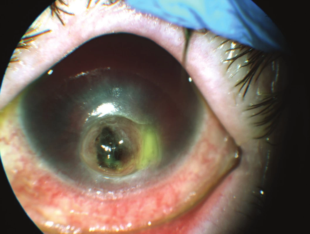 Keratomalacia with extensive perforation of the cornea