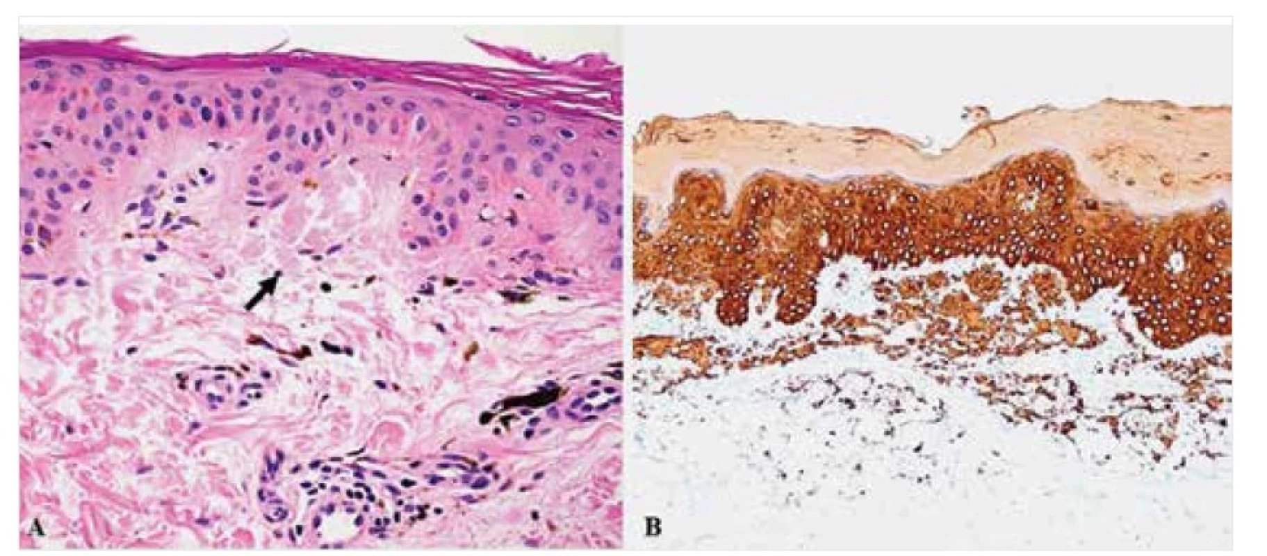 Makulózní amyloidóza – histopatologie<br>
Drobná amorfní depozita amyloidu v papilární dermis (šipka) v barvení HE (A), pozitivní v imunohistochemických
reakcích s primární protilátkou proti HMWCK (B). Původní zvětšení 400krát (A) a 100krát (B).