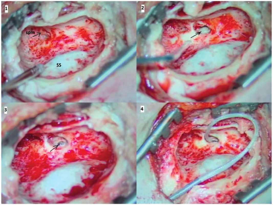 Kochleární implantace.<br>
Legenda: 1- anstromastoidektomie se skeletizací esovitého splavu
(SS) a identifikací krátkého raménka kovadlinky (spm), 2 - zadní
tympanotomie, šipkou označeno promontorium s převisem kulatého
okénka, 3 - stav po snesení převisu kulatého okénka, šipkou
označena plně vizualizovaná sekundární membrána, 4 - inzerovaný
elektrodový svazek přes okrouhlé okénko.