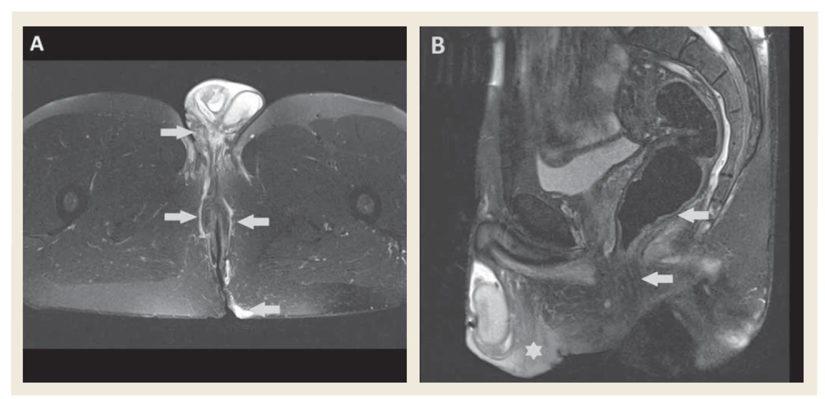 MR vyšetrenie, T2 váženie s potlačením signálu tuku – A) transverzálny rez, zobrazujú sa obojstranné fistuly v oblasti
perinea zasahujúce ventrálne na skrotum a dorzálne do gluteálnej oblasti (šípky). B) sagitálny rez, viditeľný edém
skróta a perinea (hviezdička), análne sfinktre intaktné, stena rekta bez zhrubnutia (šípky).<br>
Fig. 4. MR imaging, fat suppressed T2 image – A) axial view, bilateral fistulae in perineal region extending to scrotum and to
gluteal region (arrows). B) sagittal view, scrotal and perineal oedema (star), anal sphincters are not affected, rectal wall
without thickening (arrows).