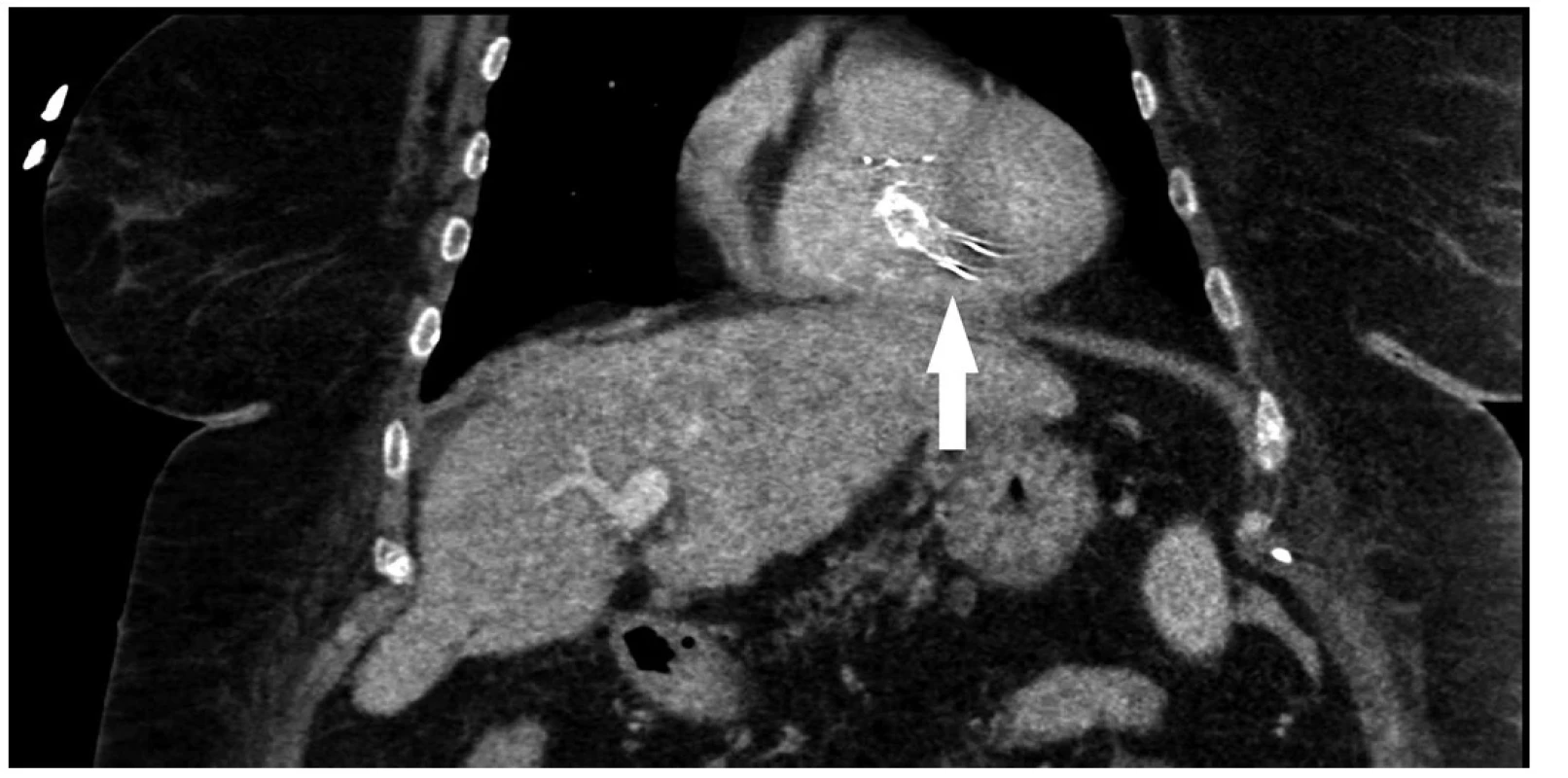 CT snímek s nálezem TIPS v pravé komoře