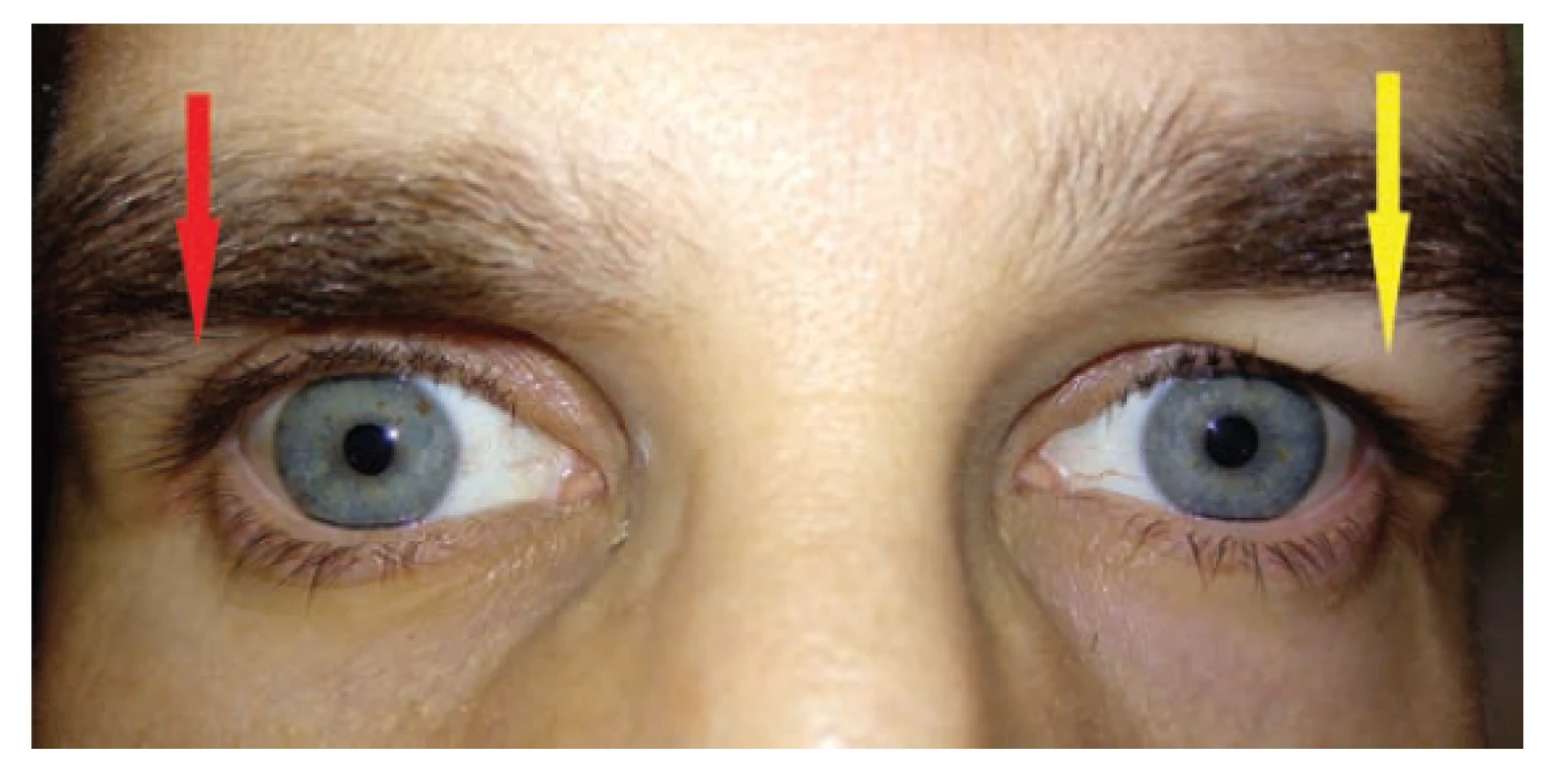 Blefarochalasis levého oka. Na pravém oku lze tušit
místo blefarochalasy hlubokou orbitopalpebrální rýhu