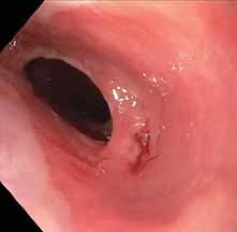 Stenóza v proximálním jícnu
v terénu atypické sliznice.<br>
Fig. 2. Stenosis in the proximal esophagus in the field of atypical mucosa.