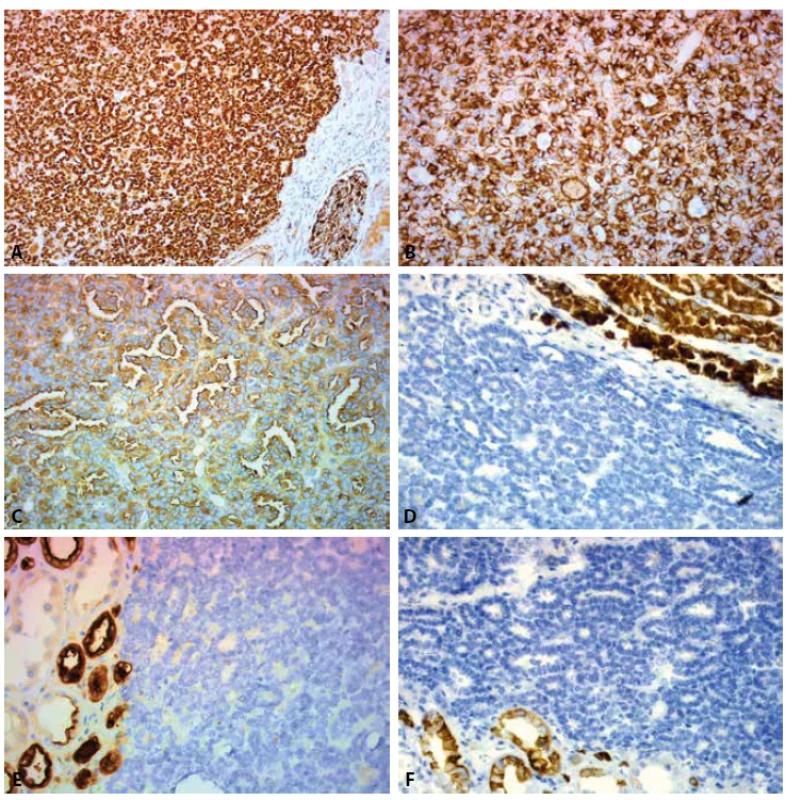 Expression of IHC markers: A. WT1 nuclear expression. Positive control – glomerulus in the adjacent renal parenchyma (200x). B. VIM cytoplasmatic
expression (400x). C. CD57 cytoplasmatic expression (400x). D. Negativity for AMACR in tumor cells. Positive control – kidney proximal
tubules (400x). E. Negativity for EMA in tumor cells. Positive control – kidney distal tubules (400x). F. Negativity for CK7 in tumor cells. Positive
control – kidney collecting ducts (400x).