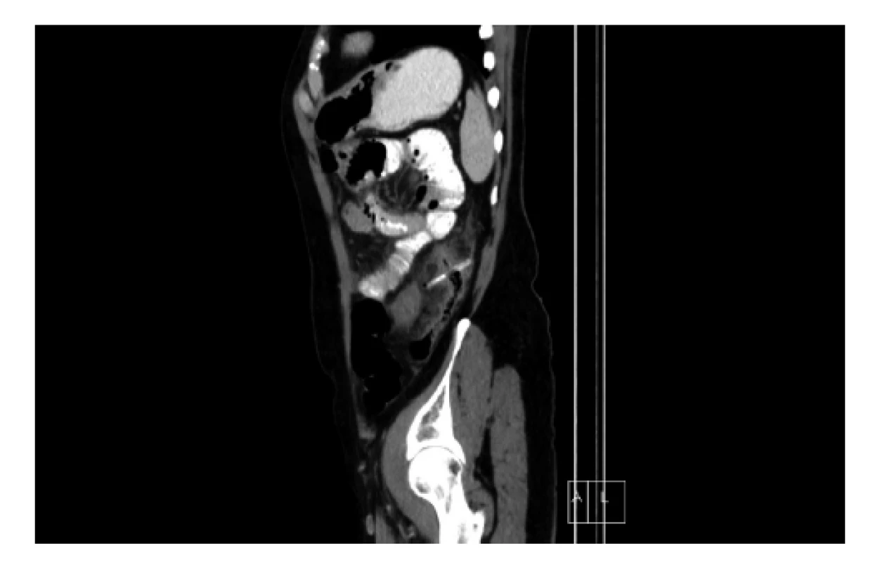 Sagitální CT řez s nálezem cizího tělesa v sestupném
tračníku<br>
Fig. 1: Sagittal CT section with finding of a foreign body in
the descending colon