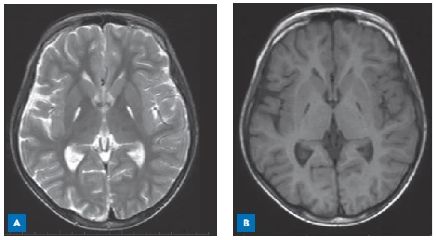 MR CNS 14letého chlapce
s methylmalonovou acidurií. V oblasti
globus pallidus jsou symetrická
pruhovitá ložiska zvýšeného signálu
v T2-vážených obrazech (A) a sníženého
signálu v T1-vážených obrazech (B).
(S laskavostí poskytla Radiodiagnostická
klinika VFN a 1. LF UK, Praha.)