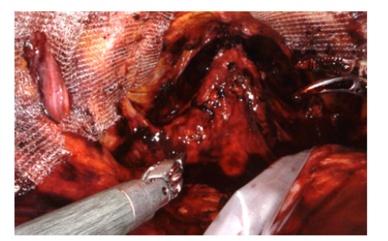 Pohled do pánve na konci operace, po obou
stranách patrná síťka<br>
Fig. 9. View into the pelvis at the end of the operation,
mesh is visible on both sides