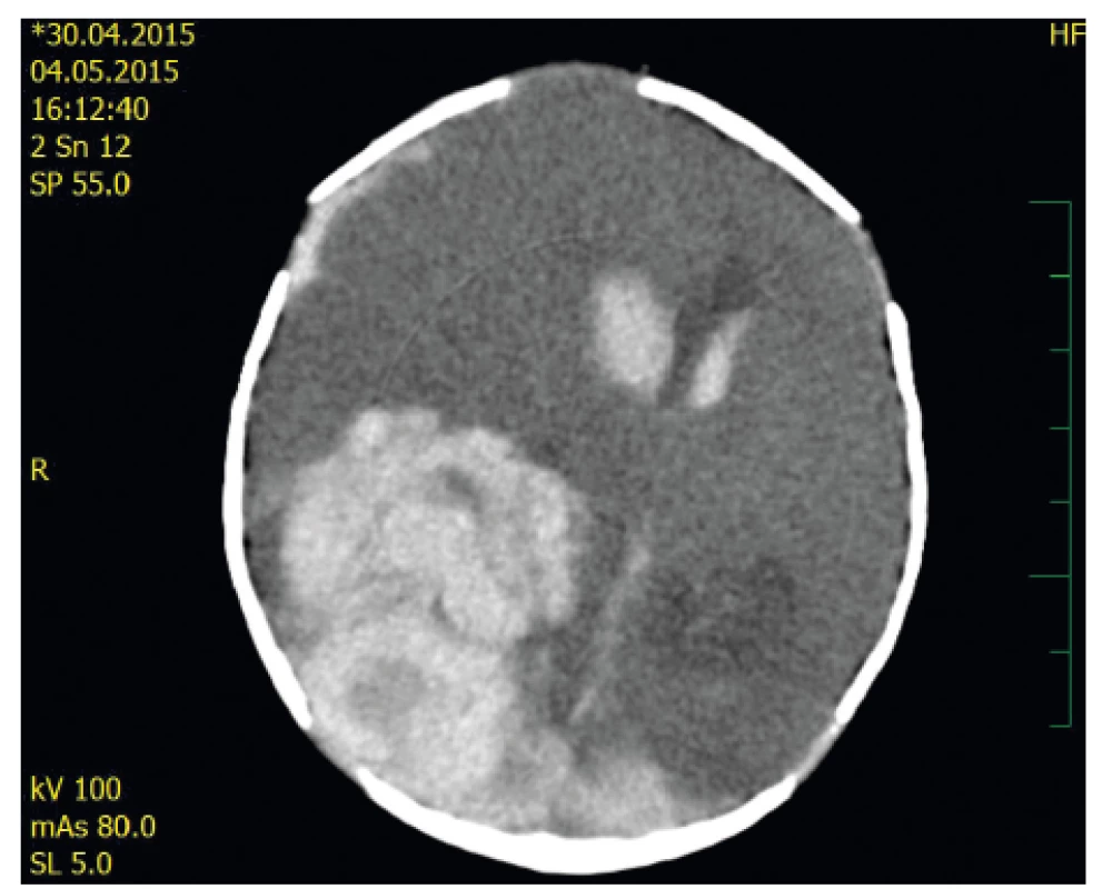 Akutně provedené CT – axiální řez: Jsou patrné denzity
čerstvé krve v obou postranních komorách, přesun
středočárových struktur při extenzivním intraparenchymovém
hematomu P-O vpravo, dále subdurální
hematom l. dx.<br>
Fig. 1. Acute CT scan – axial view: Right P-O acute
hemorrhage with midline shift is demonstrated as
well as bilateral intraventricular bleeding and right
F-P subdural haematoma.