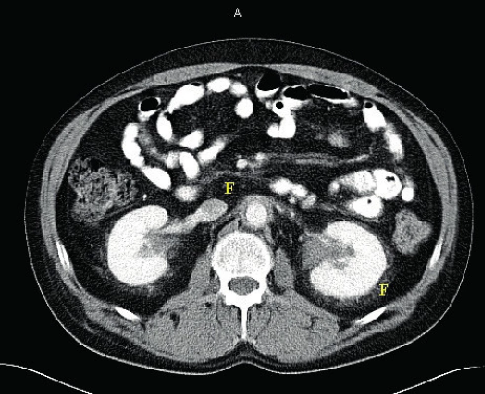  CT břicha se zřetelnými fibrotickými perirenálními změnami
typu „hairy kidney“ čili vlasaté ledviny u pacienta s ECD
