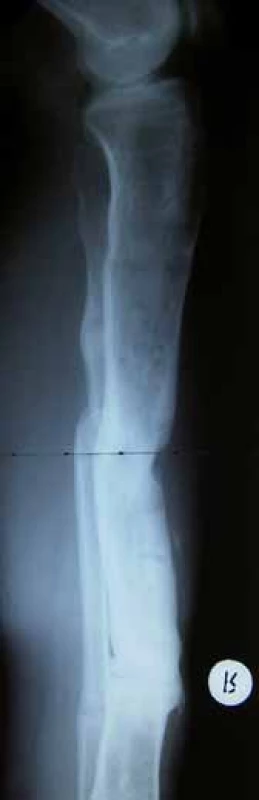 Situation after healing,
lateral projection