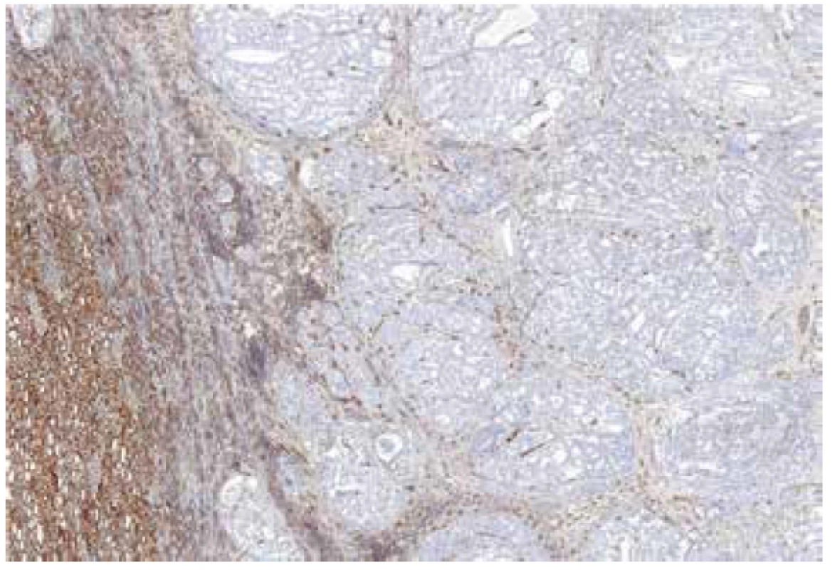 Renal cell carcinoma mimicking FHRCC (no mutation/LOH of FH gene
detected) with negative immunohistochemical staining for FH. 40x