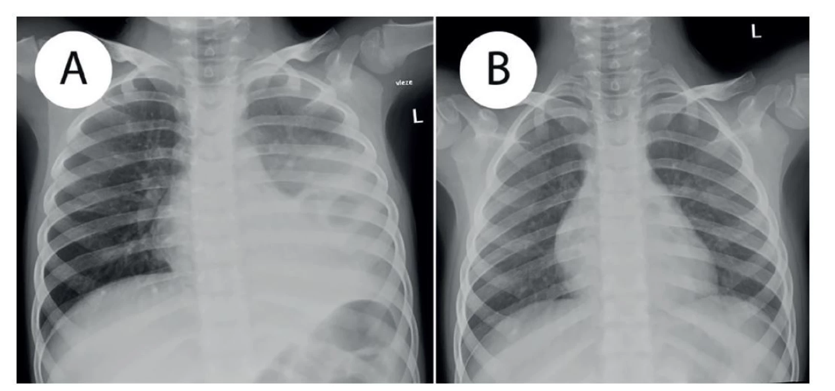 a) Prostý RTG snímek hrudníku v AP projekci, vleže − st. p. levostranné pleuropneumonii s parciálním provzdušněním
horního a středního plicního pole, b) Prostý RTG snímek hrudníku v AP proj., vleže − kontrolní snímek
4 měsíce po prodělané levostranné pleuropneumonii, restituce ad integrum.<br>
Fig. 3: a) Plain chest radiograph, AP view, supine − st. p. left sided pleuropneumonia with a partial improvement of
aeration in the upper and middle lobes; b) Plain chest radiograph, AP view, supine − FU examination 4 months after
left sided pleuropneumonia; complete normalization of the findings.