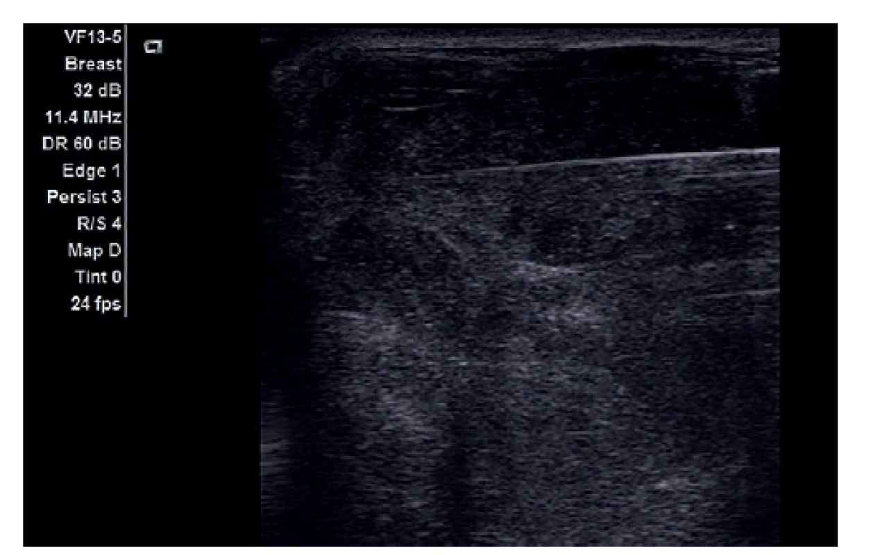 Bioptická verifikace tumorozní infiltrace prsu pod
UZ kontrolou.<br>
Fig. 3: Ultrasound guided biopsy of the tumor infiltration
of the breast.