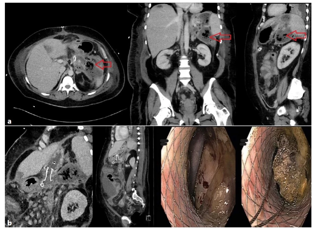 a−2b: Těžký průběh alkoholické pankreatitidy s MOF u 41leté pacientky<br>
Chirurgická revize dutiny břišní a laparostoma pro kompartment syndrom. Ohraničená kolekce tekutiny v epigastriu s bublinami
plynu velikosti 65×140×185 mm (Obr. 2a), perkutánní drén nefunkční. Kolekce byla drenována transgastricky kovovým lumen
apozičním stentem (Obr. 2b). Po opakované nekrektomii regrese ložiska. Délka hospitalizace 269 dnů, z toho ventilována 92 dnů.<br>
Fig. 2a−2b: Severe course of alcoholic pancreatitis with MOF in a 41-year-old woman<br>
Surgical revision with a laparostoma due to compartment syndrome. Circumscribed fluid collection in the epigastrium sized
65×140×185 mm with gas bubbles (Fig. 2a); the percutaneous drain was dysfunctional. The collection was drained transgastrically
by the lumen-apposing metal stent (Fig. 2b). Regression of deposits in the epigastrium after repeated necrectomy. Hospital stay
was 269 days; the patient was ventilated for 92 days.
