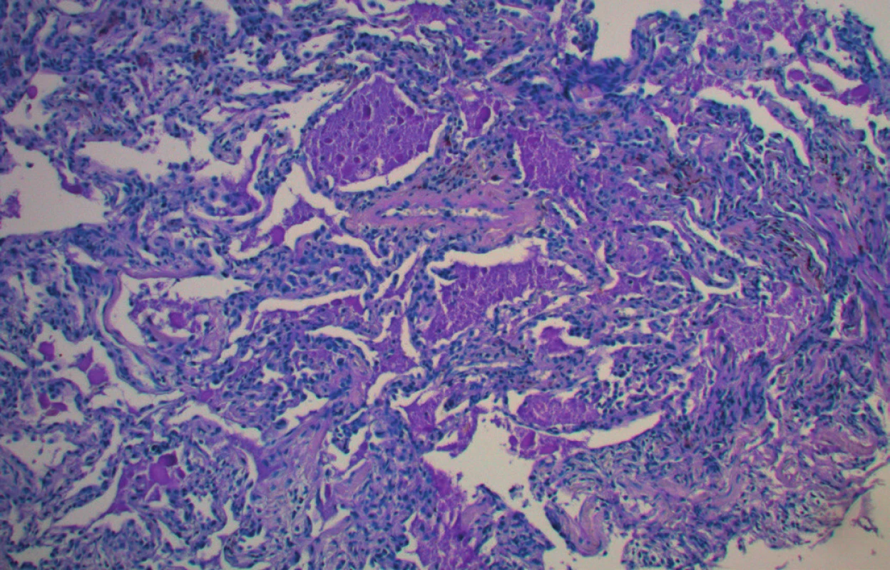 Plicní alveoly vyplněné PAS pozitivním materiálem,
zvětšeno 100×