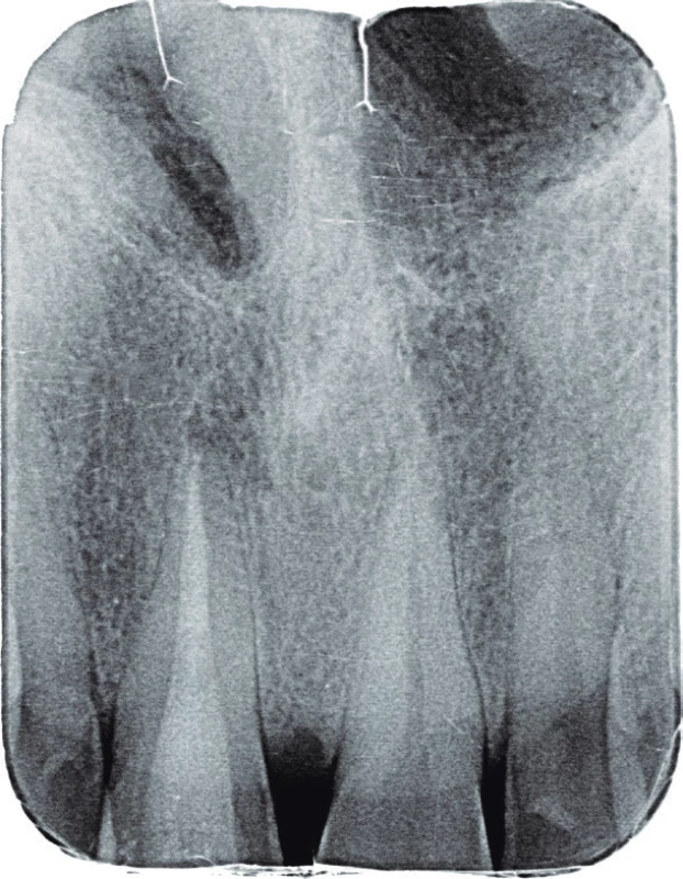 Intraorální
rentgenový snímek
zubu 11 v apikálním
zastavení po ukončeném
reendodontickém
vyšetření