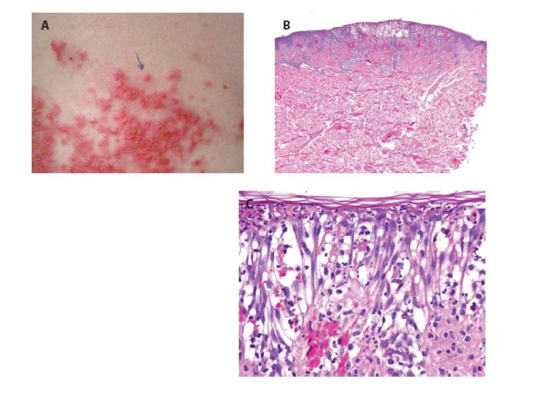 Prurigo pigmentosa<br>
a) bioptovaná papulovezikula<br>
b) perivaskulární spongiotická a vezikulózní
dermatitida s erytrocytárními extravazáty (HE
40x)<br>
c) epidermis je kryta proužkem ortokeratózy,
vykazuje výraznou spongiózu až spongiotický
intraepidermální puchýř s přítomností shluků
neutrofilů, s eytrocyty, ojedinělými eozinofily
a nekrotickými keratinocyty (HE 400x).
