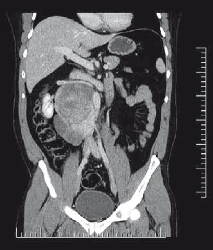CT snímky pacienta s primárně diagnostikovaným ganglioneuroblastomem retroperitonea vpravo. Pacient podstoupil nejprve biopsii z retroperitoneálního tumoru a následně dle výsledku histologie byla indikována chirurgická resekce.