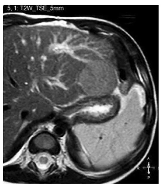Magnetická
rezonance
břicha desetiměsíčního
chlapce
s tyrosinemií
typ 1. V T2 váženém
obraze patrné
mírně hypersignální
kulovité,
ostře ohraničené
ložisko v levém
laloku jater.