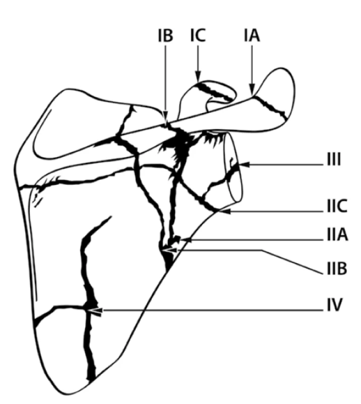 Classification of Ada and Miller. II – fractures of
scapular neck (Figure adapted from Ada and Miller, [1]).