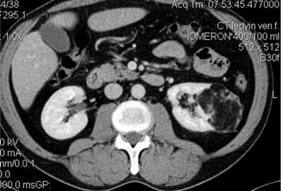 Angiomyolipom levé ledviny CT (transverzální řez)<br>
Fig 2. Angiomyolipoma of the left kidney CT (transverse section)