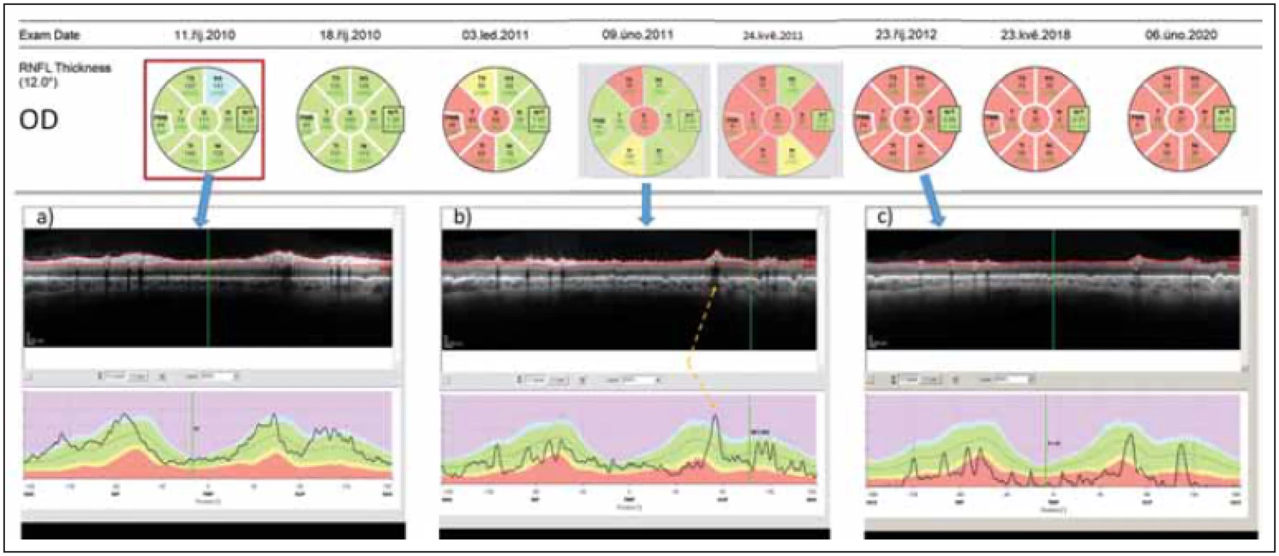 Longitudinální sledování tloušťky RNFL v peripapilární oblasti pravého oka pomocí optické koherenční tomografi e u pacientky
s AQP4-IgGpozNMOSD. V průběhu sledování proběhly dvě epizody zánětu očního nervu – na počátku října 2010 a v únoru 2011.
(a) ukazuje nález v akutní fázi zánětu.
(b) ukazuje nález po 4 měsících. Tloušťka RNFL v jednotlivých segmentech je sice ve většině segmentů v mezích normy (kódována zeleně),
avšak křivka RNFL na grafu dole je jasně oploštělá a vykazuje pokles ve všech segmentech. Na mírném zvýšení tloušťky RNFL
oproti předchozímu vyšetření se podílí edém při právě probíhající recidivě optické neuritidy ve vyšetřovaném oku. Místo, kde křivku
RNFL zvedá céva probíhající na povrchu sítnice, je označeno žlutou šipkou.
(c) ukazuje stav sítnice rok po počátku prvního zánětu. RNFL je natolik ztenčeno, že je na několika místech prakticky neměřitelné.<br>
Fig. 2. Longitudinal follow up of peripapillary RNFL thickness (right eye) in a patient with AQP4-IgGposNMOSD. Two episodes of optic
neuritis occurred during the follow-up – in October 2010 and in February 2011.
(a) shows fi nding in the acute phase of optic neuritis.
(b) shows fi ndings 4 months later. The thickness of RNFL still falls within normal values in most peripapillary segments (coded in
green) however, the curve of RNFL thickness has been fl attened and shows a loss of RNFL in all segments. A slight increase in RNFL
thickness on this day in comparison with the prior exam is caused by edema caused by the second optic neuritis in the right eye. The
blood vessels artifi cially increase the RNFL thickness (marked by a yellow arrow).
(c) shows retinal fi ndings a full year after the onset of fi rst optic neuritis in the eye. RNFL has been thinned and cannot be reliably
quantifi ed.