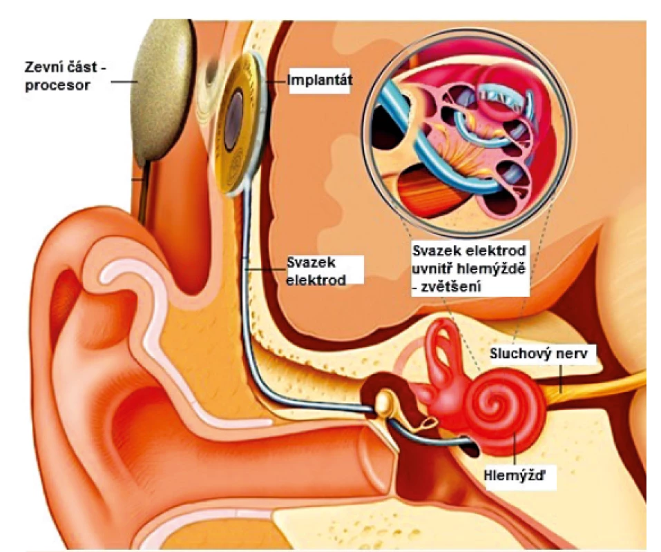 Kochleární implantát. Tvoří ho zevní část obsahující procesor
a vnitřní část implantovaná pod periostem za uchem. Svazek
elektrod je zaveden přes okrouhlé okénko přímo do hlemýždě,
kde dochází ke stimulaci vláken sluchového nervu.
Upraveno dle https://www.ucsfbenioffchildrens.org/treatments/
cochlear_implant/.