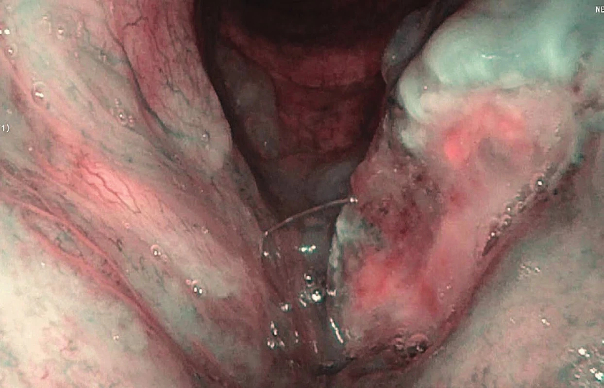 Endoskopické vyšetření s NBI – spinocelulární karcinom
levé hlasivky, v její střední části patrné patologické změny
vaskularizace