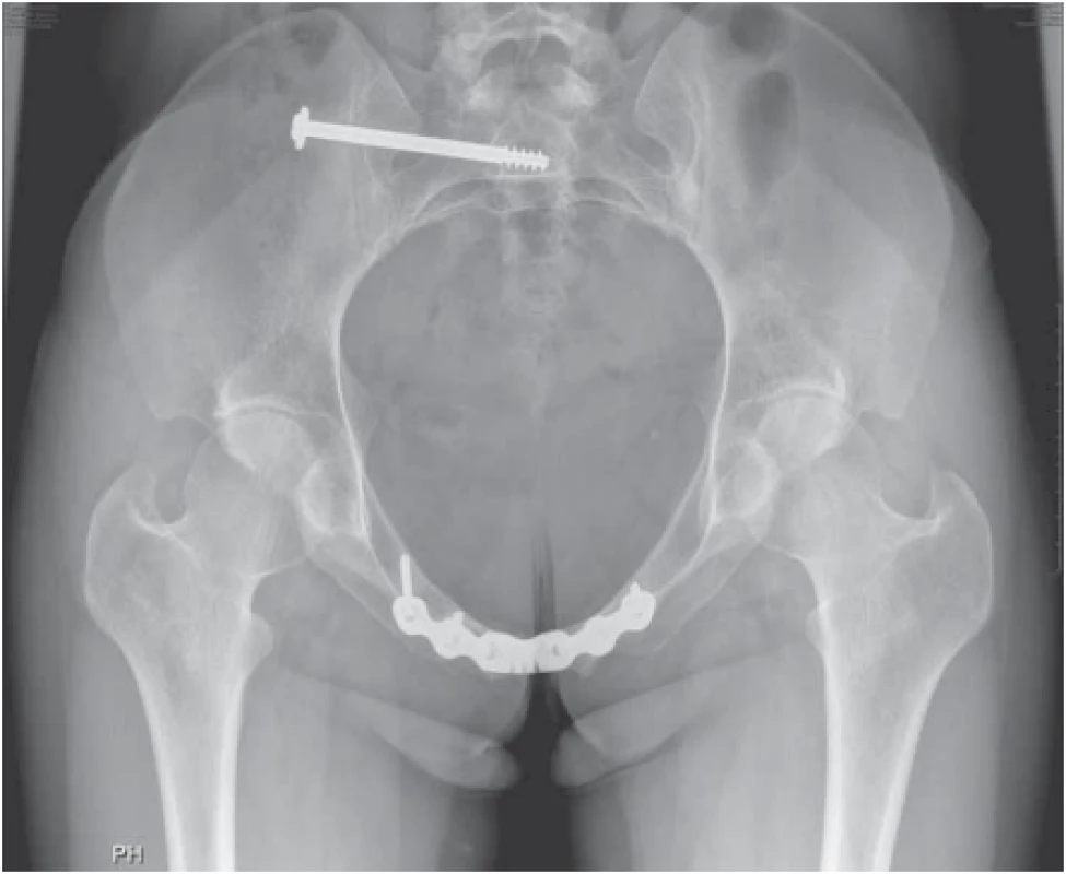 RTG snímka panvy rok po operácii so symetrickým panvovým 
pletencom.<br>
Fig. 4. X-ray of the pelvis one year after the surgery with a symmetrical pelvic 
girdle.