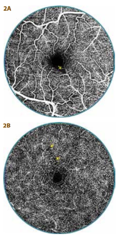  OCT-A examination of 20 year old
diabetic patient (13 year duration of diabetes) with diabetic preretinopathy (DpR)<br>
A. Superficial vascular complex with irregularity of parafoveal capillaries with zones of non-perfusion (arrow)<br>
B. The capillary network is more or less
regular in the deep vascular complex, but
in place the finding is distinguished by
thinning (arrow), surface of foveal avascular zone is narrower – 0.16 mm2