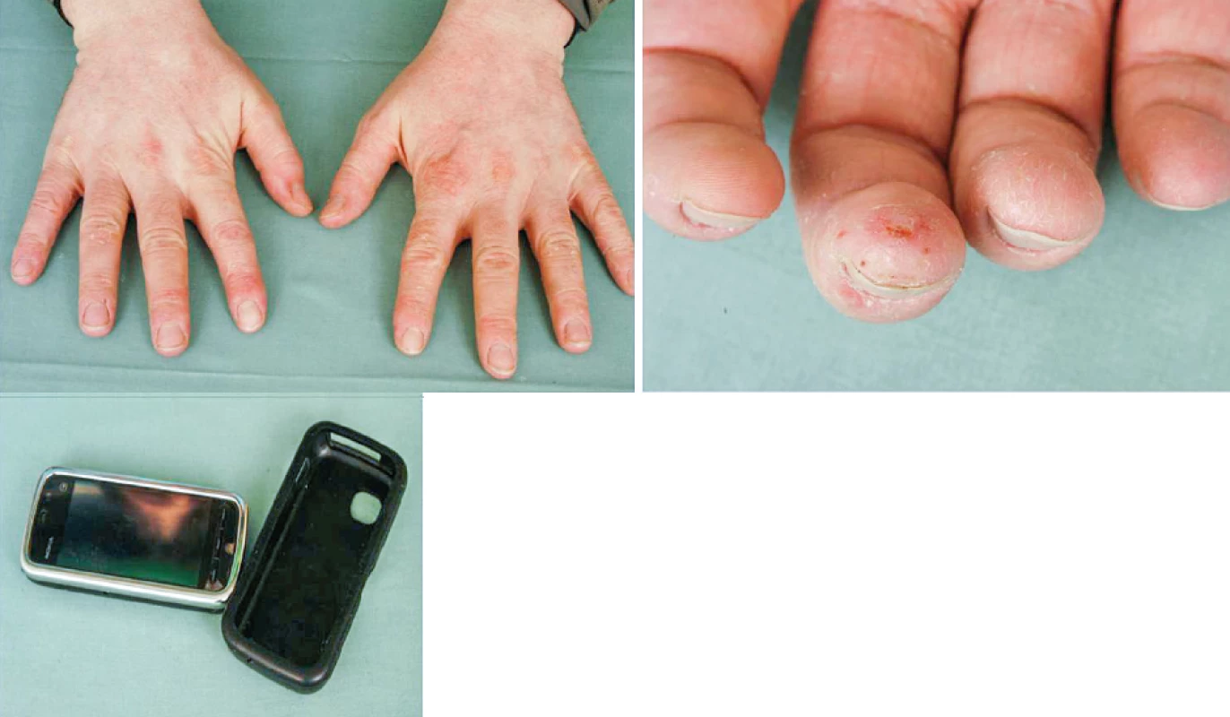 Eczema contactum et atopicum – IPPD+++ (obal mobilního telefonu), disperzní
oranž 3++, disperzní oranž 1++, lyral+-++ (kosmetické přípravky) – hodinář