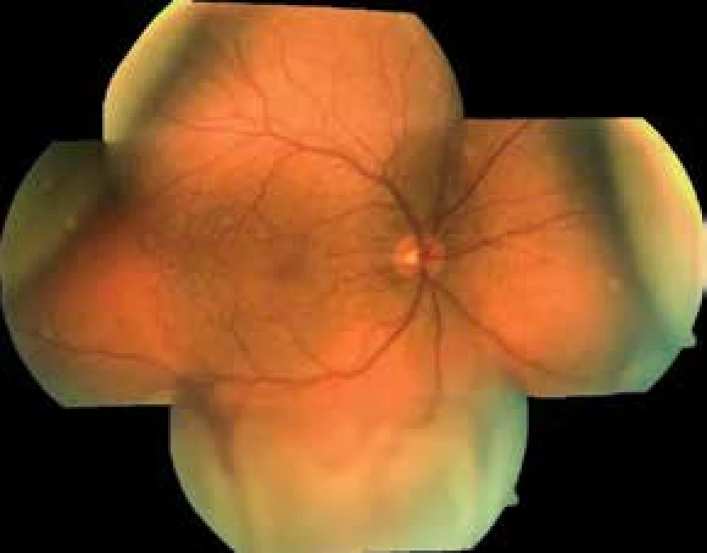 Fotografie očního pozadí pravého oka, leden 2018.
Shora ablace choroidey, zdola odchlípení sítnice s neležící makulou