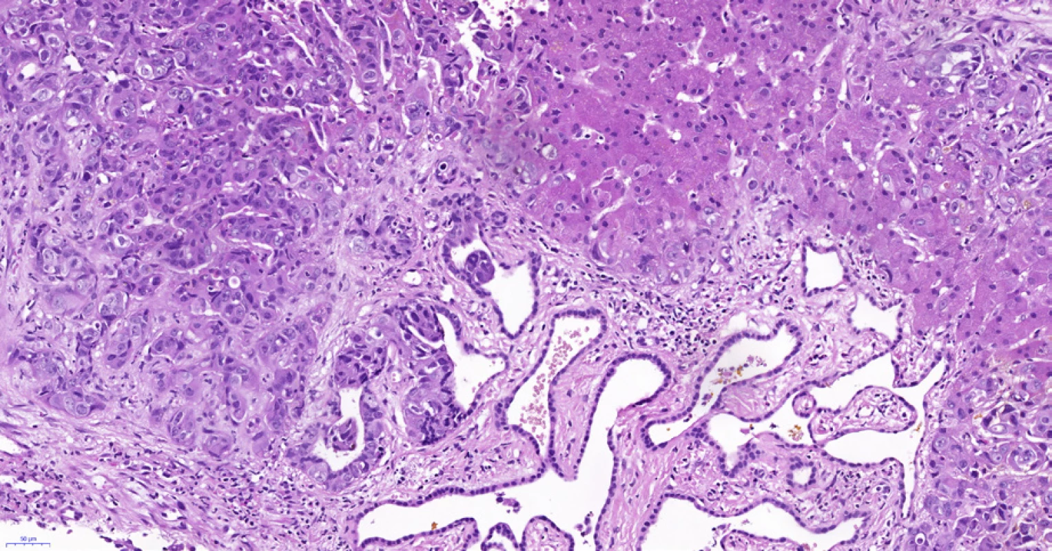 Periferní typ intrahepatálního cholangiocelulárního karcinomu, stejná biopsie jako na obr. 6 a 7. Adenokarcinom (vlevo nahoře) roste v těsné blízkosti (v terénu?) von Meyenburgova komplexu (uprostřed dole), který je tvořen angulovanými žlázkami vystlanými plochým až kubickým biliárním epitelem bez atypií. Vpravo je nenádorový parenchym jater. Histologický řez z punkční biopsie, hematoxylin-eozin, 20×.