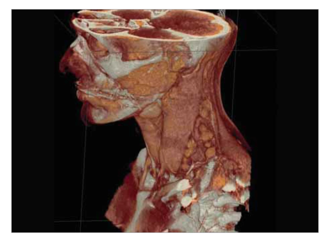CT sken krku odhaľuje zväčšené lymfatické uzliny pozdĺž
m. sternocleidomastoideus vľavo, s najväčšom uzlinou veľkosti 22 × 10 mm
(3D rekonštrukcia).<br>
Fig. 1. CT scan of the neck reveals enlarged lymph nodes along the sternocleidomastoid
muscle on the left, with the largest node measuring 22 × 10 mm
(3D reconstruction).