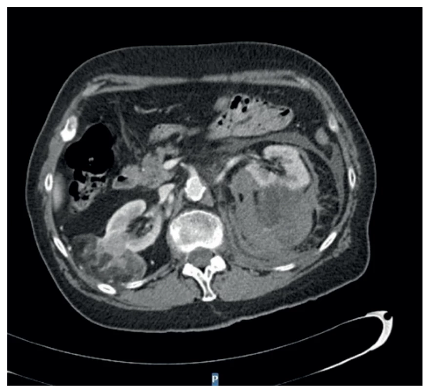 Ruptura angiomyolipomu vlevo na CT břicha<br>
Fig. 2: Rupture of the left-sided angiomyolipoma on abdominal
CT