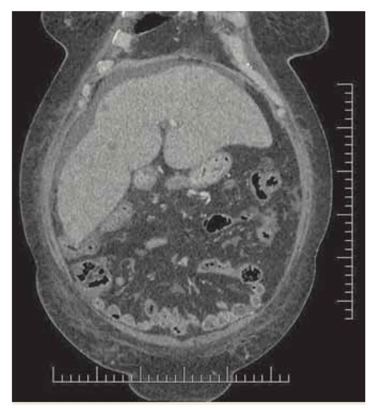 CT - koronálna multiplanárna
rekonštrukcia, venózna fáza, hypodenzné
ložiská v pravom laloku,
ascites.<br>
Fig. 3. CT – coronary multiplanar reconstruction,
venous phase, hypodense lesions
in the right lobe, ascites.