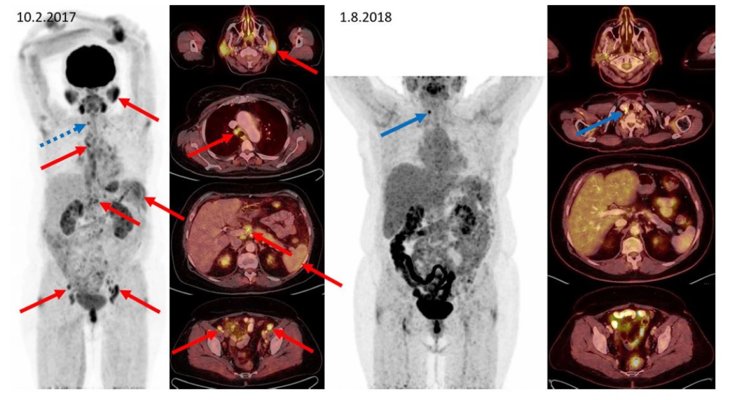 F–FD6 PET/CT vyšetření u pacientky s IgG4- RD a generalizovaným postižením. Červenými šipkami jsou označeny metabolicky aktivní infiltrace
příušních slinných žláz, zvětšená aktivní uzlina paratracheální vpravo, metabolicky aktivní slezina, uzliny periportálně a uzliny podél zevních ilických
cév oboustranně. Další nálezy: infiltrace v gll. submandibularis oboustranně, v dalších uzlinách mediastina, břicha i retroperitonea a presakrálně jsou
patrny na MIP zobrazení, ale nejsou označeny. Všechna tato metabolicky aktivní ložiska při kontrolním vyšetření po léčbě rituximabem, cyklofosfamidem
a dexametazonem zanikají. Jen v pravém laloku štítnice (označeno modře) se zvyšuje aktivita a při přešetření štítnice byl později prokázán papilokarcinom