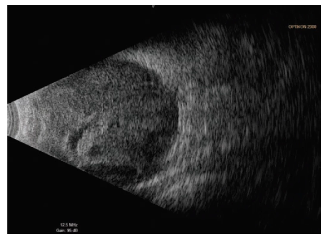 Ultrazvukové vyšetření (UZ) levého bulbu 7.
den po TE OL