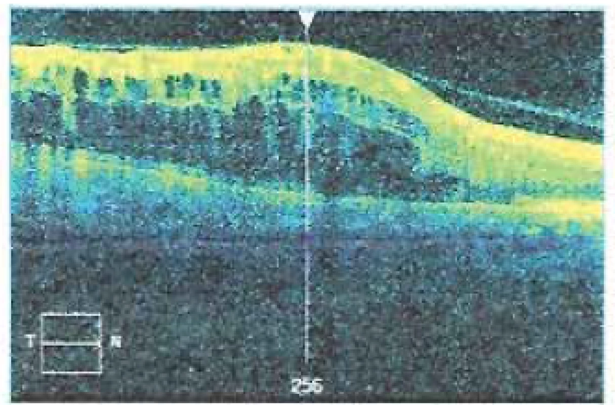Snímek optické koherenční tomografie u téhož
pacienta pořízený při indikaci intravitreální léčby ranibizumabem,
centrální retinální tloušťka 759 μm, makrocystický
edém v oblasti horních 2/3 centrální krajiny
